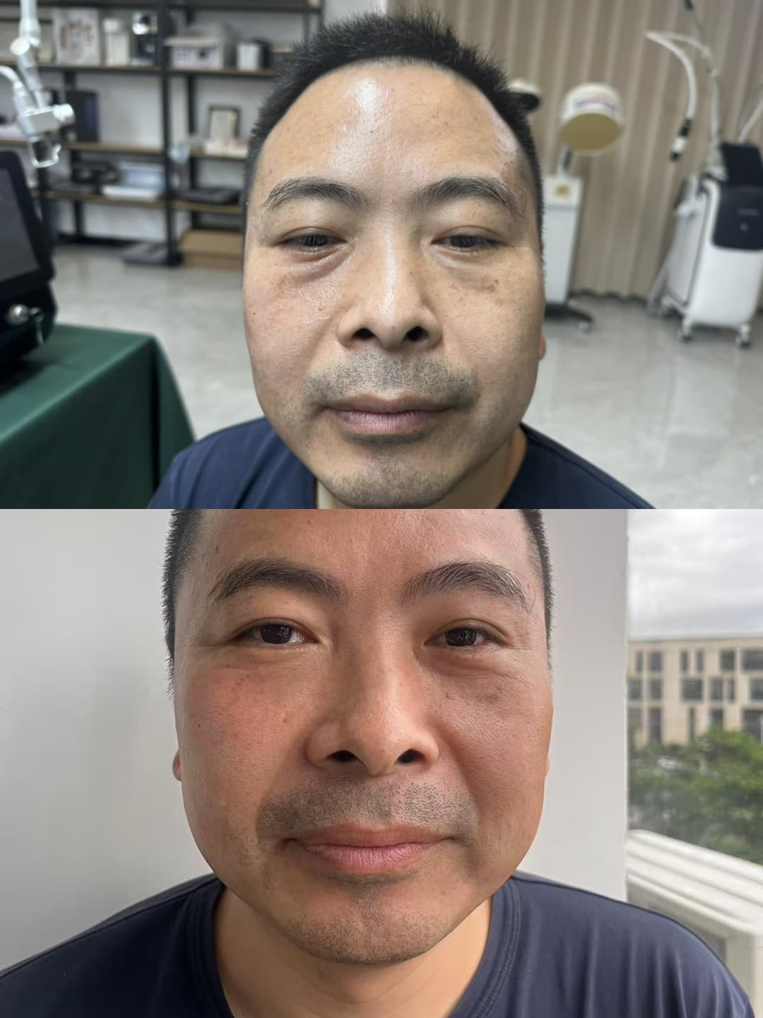 HOAO BEAUTY EyeLift Prestige HE™